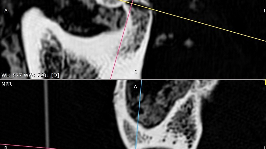 Woman who died 2,500 years ago survived complex jaw surgery after a severe head injury - CT scans reveal the earliest known example of such an operation in ancient Siberia.