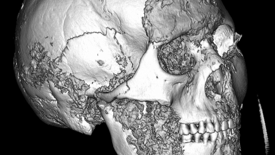 Woman who died 2,500 years ago survived complex jaw surgery after a severe head injury - CT scans reveal the earliest known example of such an operation in ancient Siberia.