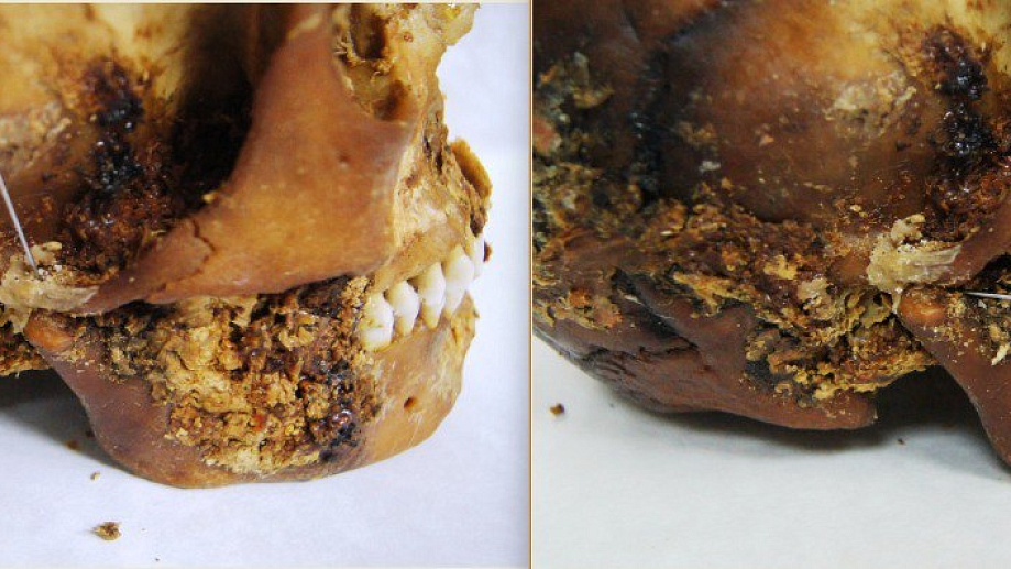Woman who died 2,500 years ago survived complex jaw surgery after a severe head injury - CT scans reveal the earliest known example of such an operation in ancient Siberia.