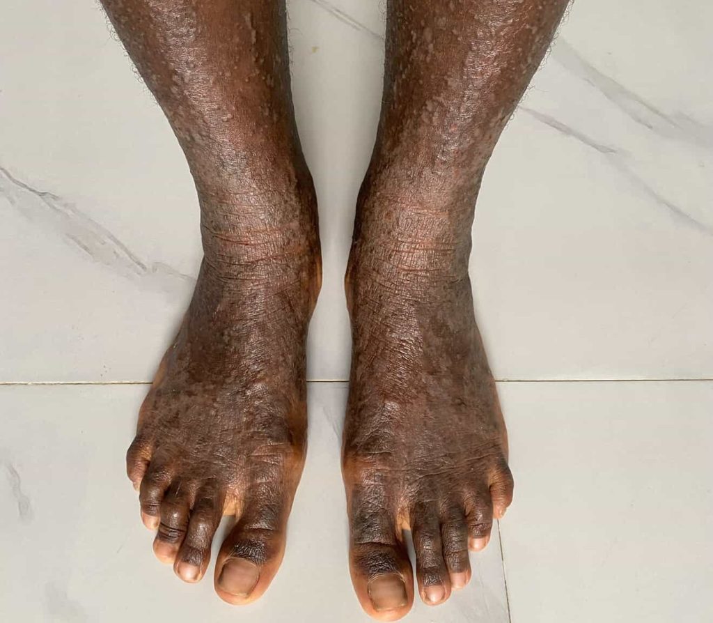 A London woman felt like a "prisoner in her own body" after a rare condition left her skin constantly peeling, oozing and shedding - until diet changes and holistic healing transformed her life.