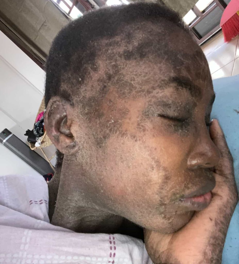 A London woman felt like a "prisoner in her own body" after a rare condition left her skin constantly peeling, oozing and shedding - until diet changes and holistic healing transformed her life.