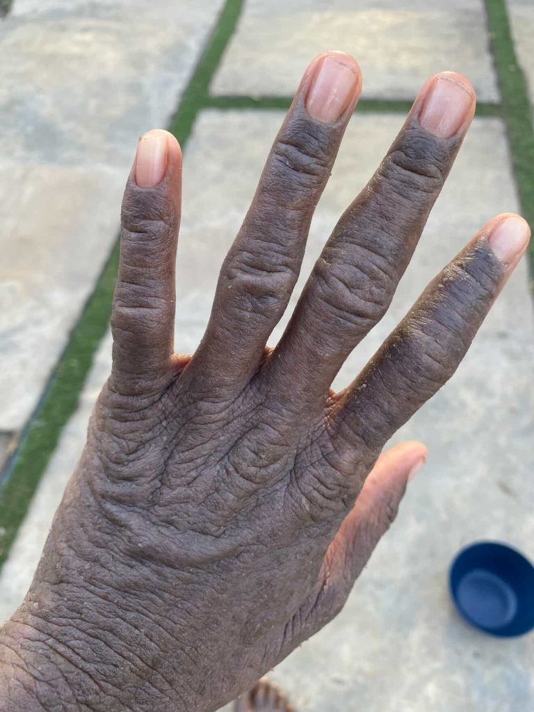 A London woman felt like a "prisoner in her own body" after a rare condition left her skin constantly peeling, oozing and shedding - until diet changes and holistic healing transformed her life.