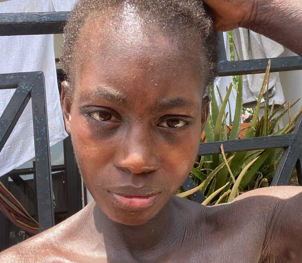 A London woman felt like a "prisoner in her own body" after a rare condition left her skin constantly peeling, oozing and shedding - until diet changes and holistic healing transformed her life.