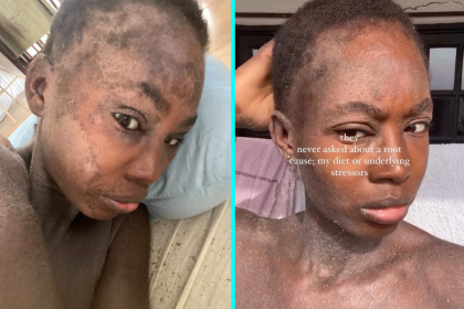 A London woman felt like a "prisoner in her own body" after a rare condition left her skin constantly peeling, oozing and shedding - until diet changes and holistic healing transformed her life.