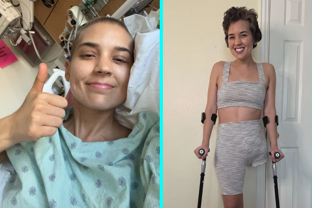 Woman, 30, told to stretch leg for pain ends up needing rarest amputation in world after bone cancer diagnosis. Courtney Echerd had leg and part of pelvis removed.