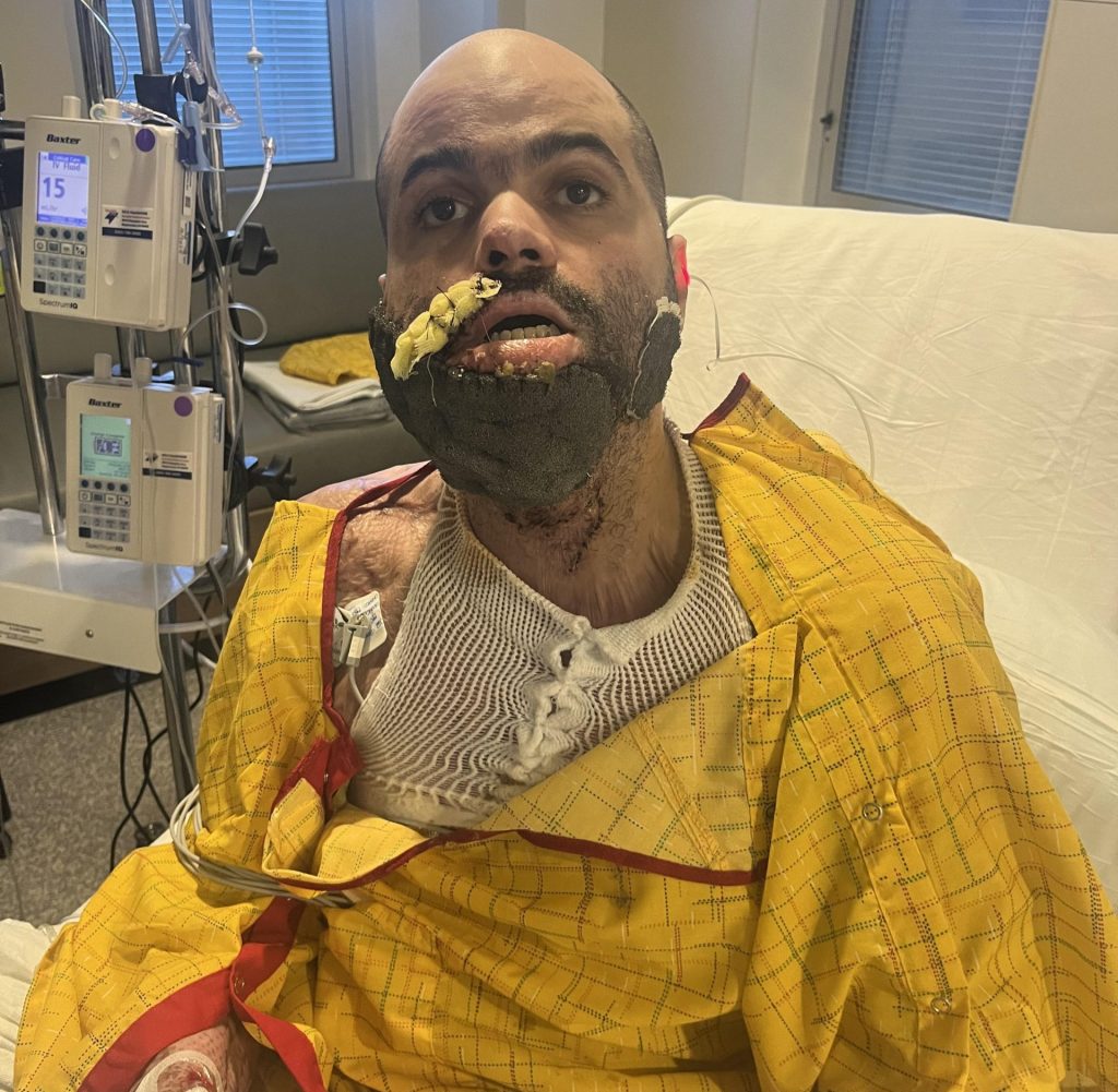 A nursing student trapped in a car fire suffered burns to half his body and endured 50 surgeries - now he helps other burn survivors find housing and hope.