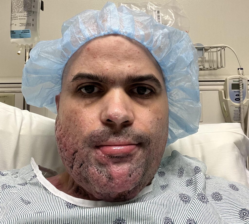 A nursing student trapped in a car fire suffered burns to half his body and endured 50 surgeries - now he helps other burn survivors find housing and hope.