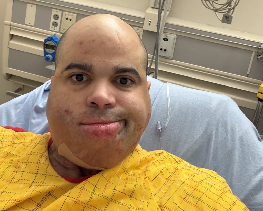 A nursing student trapped in a car fire suffered burns to half his body and endured 50 surgeries - now he helps other burn survivors find housing and hope.