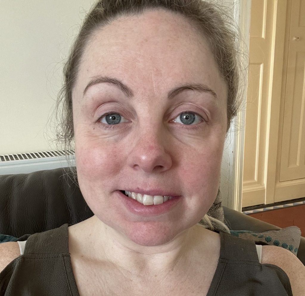 Mum Charlie Beswick woke up with slurred speech and a droopy face months before her wedding - she was diagnosed with Bell's Palsy and feared it could become permanent.