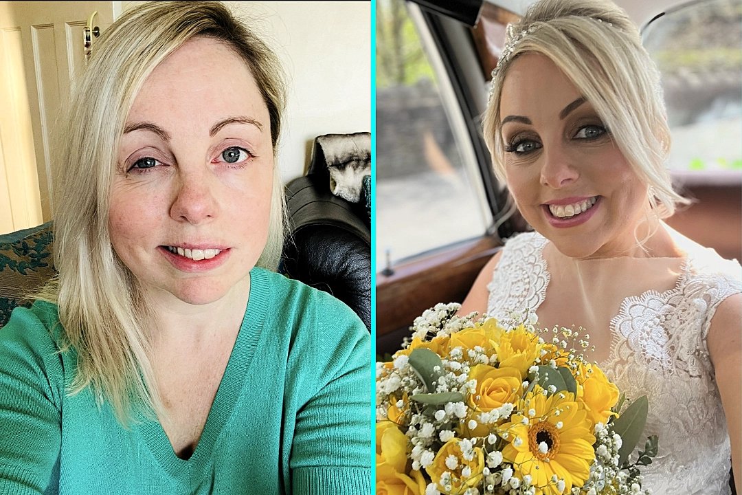 Mum Charlie Beswick woke up with slurred speech and a droopy face months before her wedding - she was diagnosed with Bell's Palsy and feared it could become permanent.