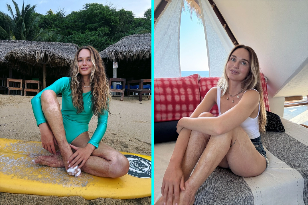 Burn survivor Katya Komleva who lost most of her toes and spent two years in a wheelchair is now chasing her dream of becoming a professional surfer after a life-changing accident.
