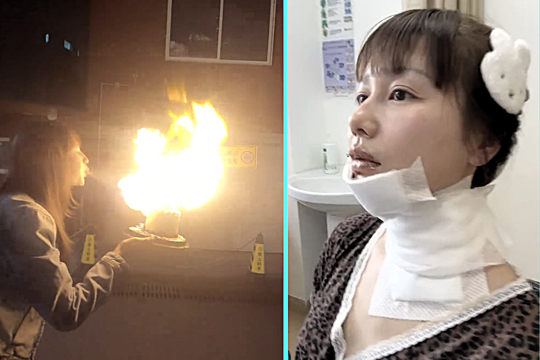 Actress Wang Tianyu suffered horrific burns to her face after trying a viral birthday cake fire-breathing stunt - saying she thought it was safe because no one warned of risks.
