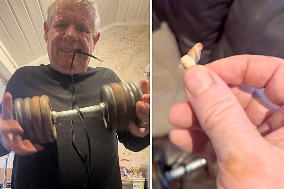 A man in agony pulled out his own tooth using weights and vodka after failing to access NHS care, as the UK dental crisis drives patients to desperate measures.