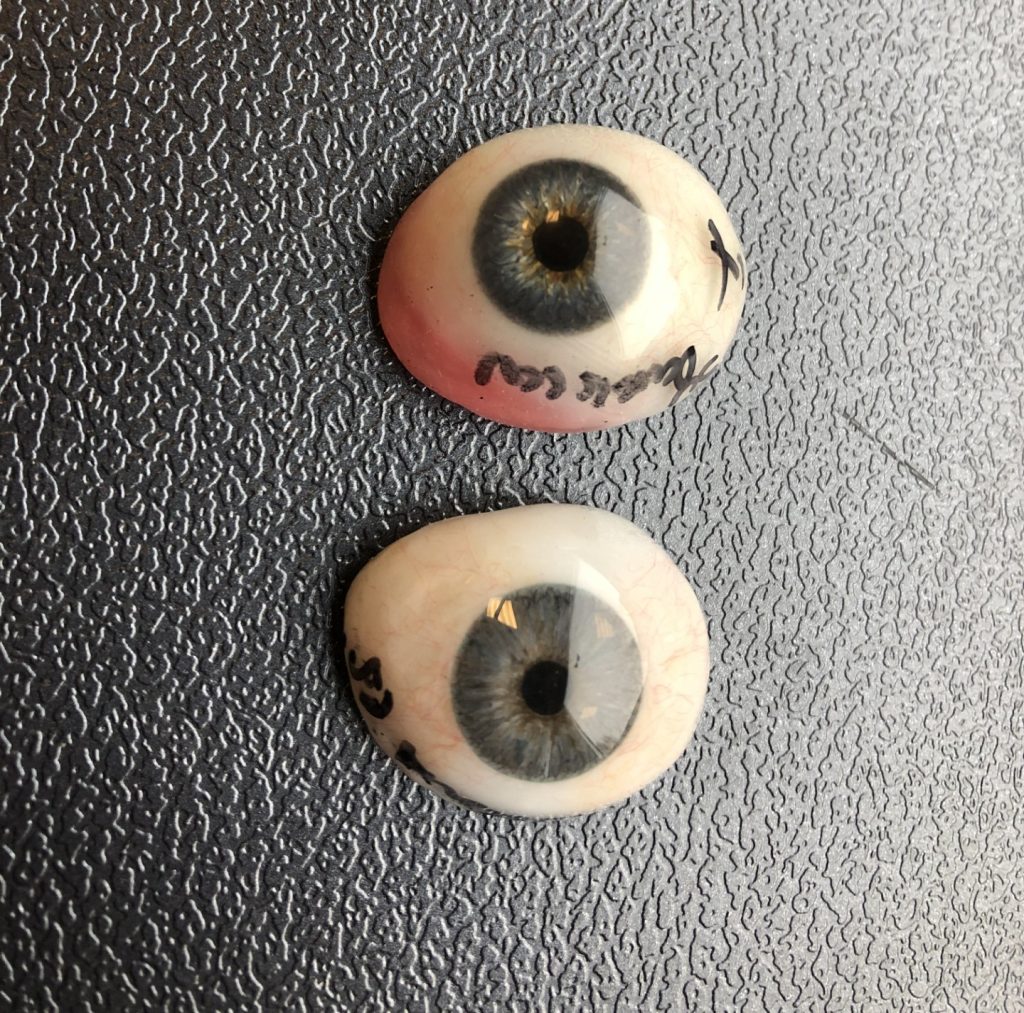 A British dad had his eyeball removed after a stranger's fingernail slashed his eye during a pool volleyball game on a family holiday in Mexico - leaving him blind in one eye.