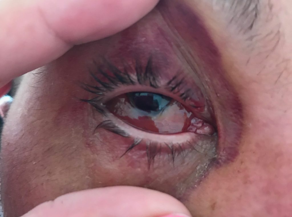 A British dad had his eyeball removed after a stranger's fingernail slashed his eye during a pool volleyball game on a family holiday in Mexico - leaving him blind in one eye.
