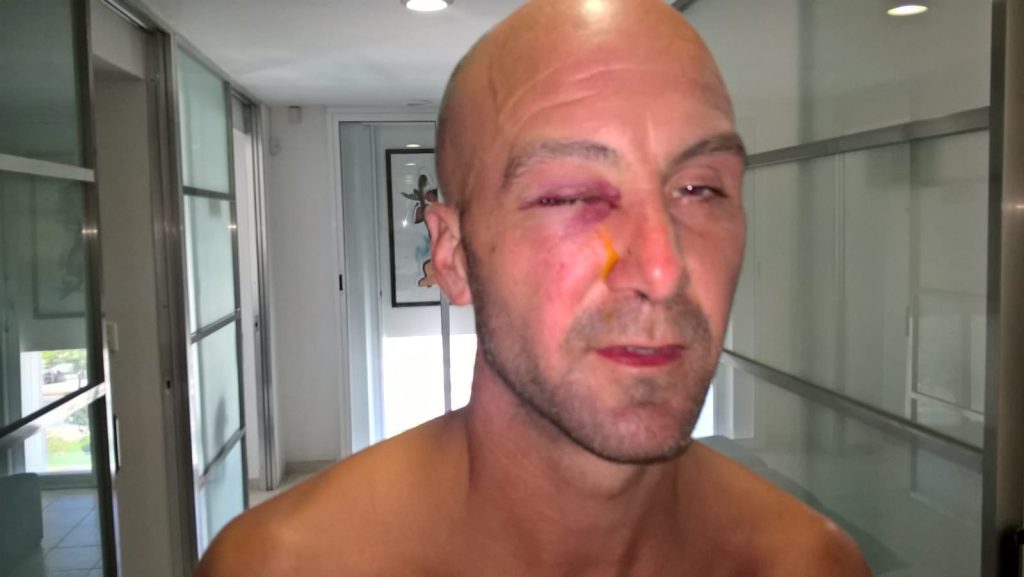 A British dad had his eyeball removed after a stranger's fingernail slashed his eye during a pool volleyball game on a family holiday in Mexico - leaving him blind in one eye.