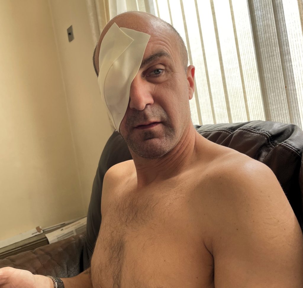 A British dad had his eyeball removed after a stranger's fingernail slashed his eye during a pool volleyball game on a family holiday in Mexico - leaving him blind in one eye.