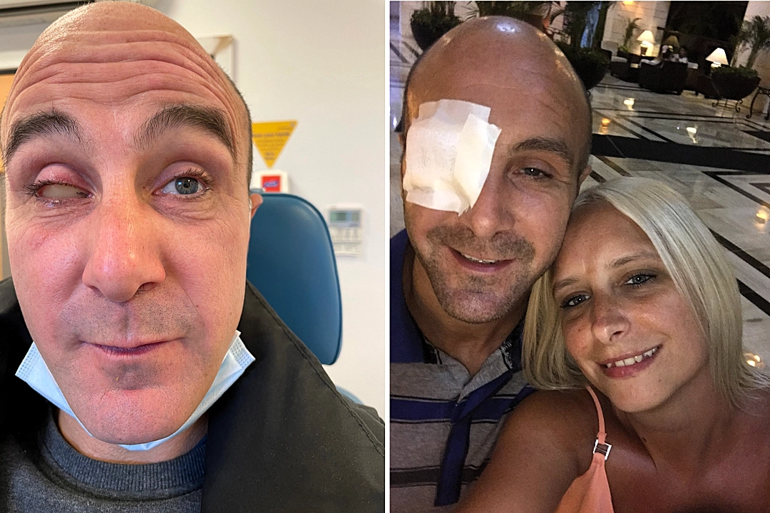 A British dad had his eyeball removed after a stranger's fingernail slashed his eye during a pool volleyball game on a family holiday in Mexico - leaving him blind in one eye.