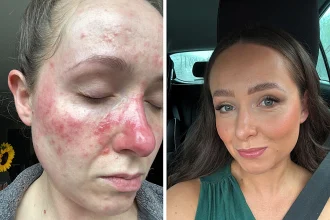 British mum who refused to open blinds without makeup reveals the £16 miracle serum that transformed her painful acne-covered skin and made her unrecognisable in months.