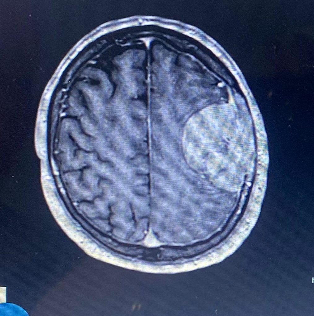 Stuart Hill suffered migraines for over 20 years before doctors found a brain tumour attached to his skull - now he struggles to speak after a stroke following surgery.