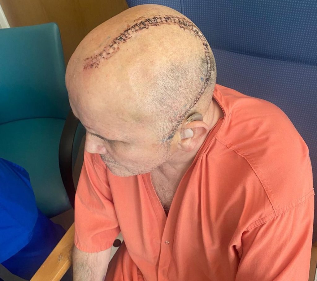 Stuart Hill suffered migraines for over 20 years before doctors found a brain tumour attached to his skull - now he struggles to speak after a stroke following surgery.