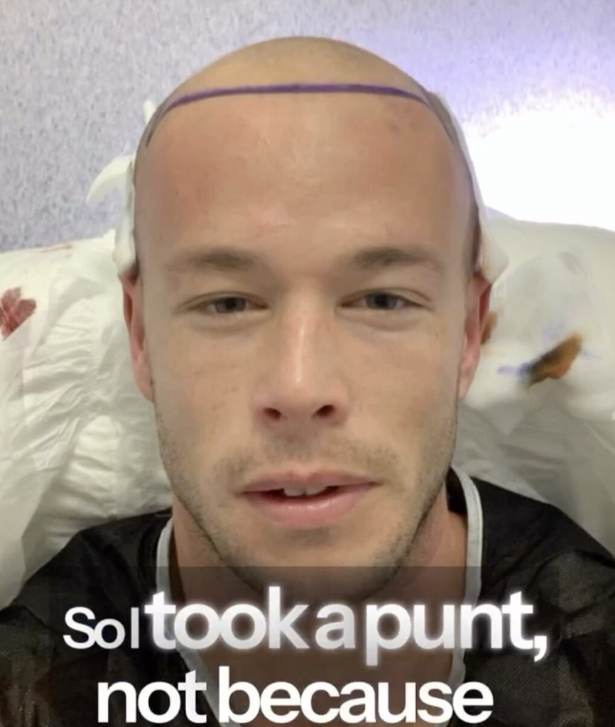 Firefighter nicknamed Baldilocks says he felt second best for years before a Turkey hair transplant changed his life - even inspiring him to quit his job and follow his dream.