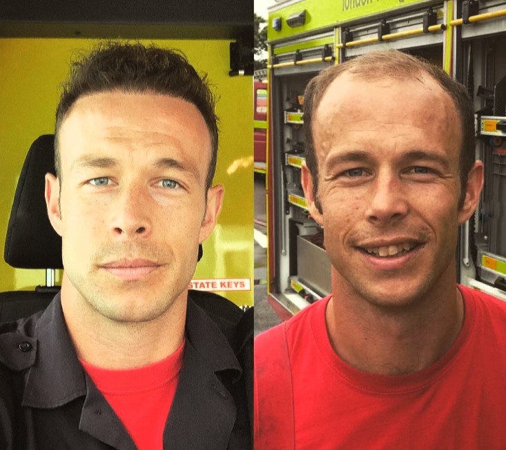 Firefighter nicknamed Baldilocks says he felt second best for years before a Turkey hair transplant changed his life - even inspiring him to quit his job and follow his dream.