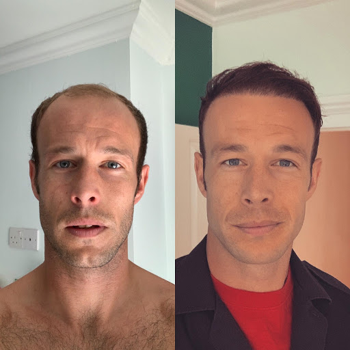 Firefighter nicknamed Baldilocks says he felt second best for years before a Turkey hair transplant changed his life - even inspiring him to quit his job and follow his dream.