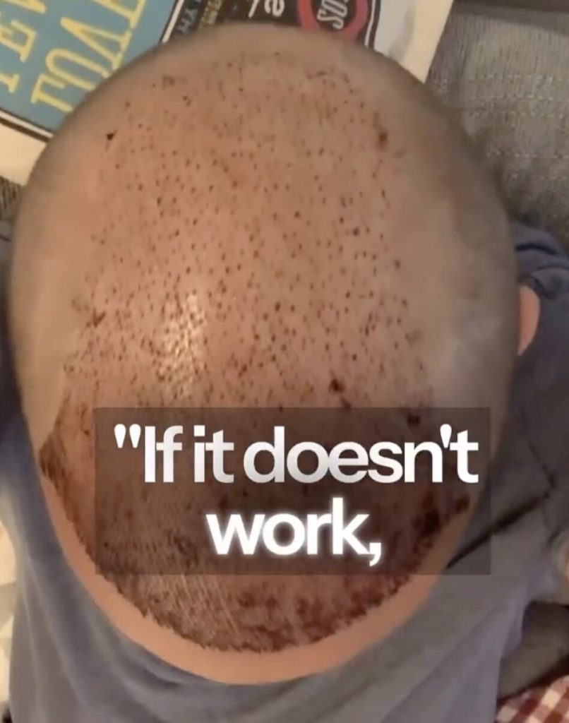 Firefighter nicknamed Baldilocks says he felt second best for years before a Turkey hair transplant changed his life - even inspiring him to quit his job and follow his dream.