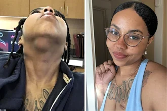 A woman watched cancer spread across her body for years after doctors repeatedly misdiagnosed her stage 4 lymphoma as eczema - now she's been in remission for five years.