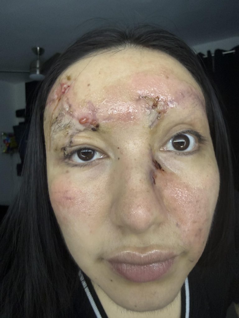 Influencer left with severe facial injuries after being flung from her car in a horror crash while speeding without a seatbelt - now sharing her recovery to warn others.