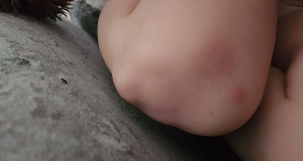 A Scottish mum shares how her toddler was diagnosed with Juvenile Idiopathic Arthritis after months of being told her pain was just growing pains - here is Skyla's story.