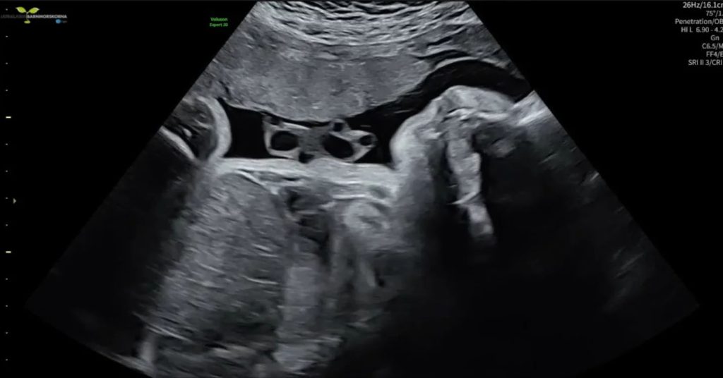 Reality star discovers she is seven months pregnant after feeling kicks in her belly - she had no idea and had been living life as usual with no symptoms until that moment.