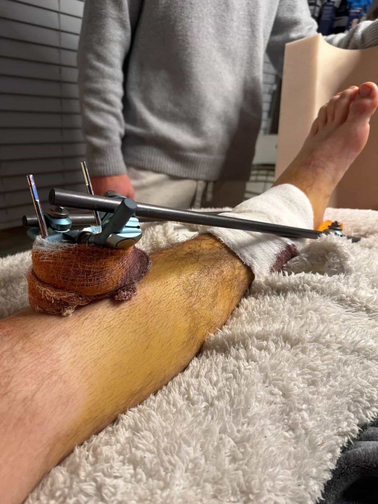 Teen dirt biker Dylan Collins suffers life-changing injuries after e-bike malfunction sent him flying into a tree - snapping his tibia, fibula and shattering his ankle.