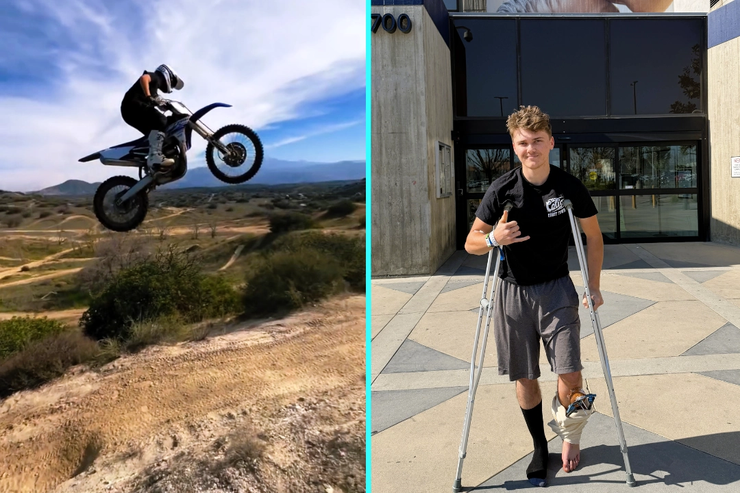 Teen dirt biker Dylan Collins suffers life-changing injuries after e-bike malfunction sent him flying into a tree - snapping his tibia, fibula and shattering his ankle.
