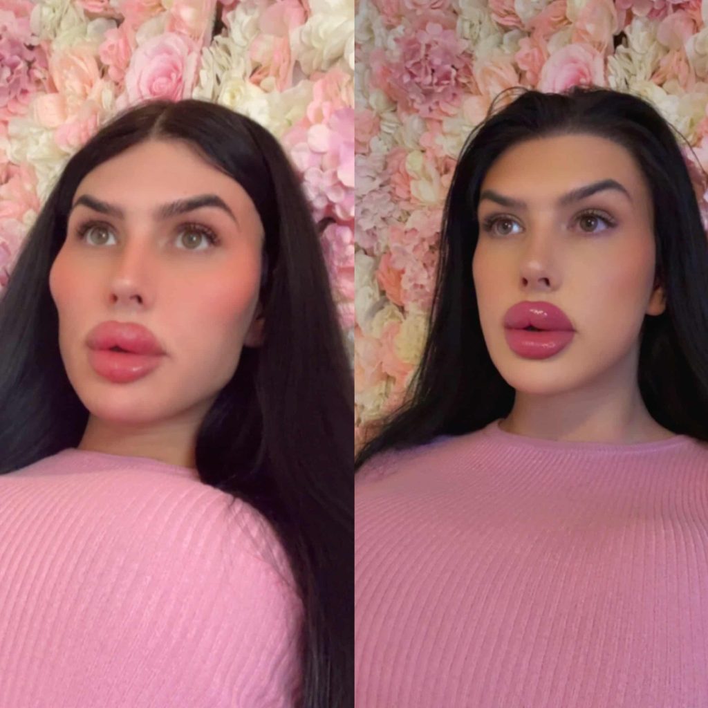 Sofia Lips spent over £500,000 on surgery and now dissolves filler to reveal her natural face for the first time in 10 years - but says she feels embarrassed without it.