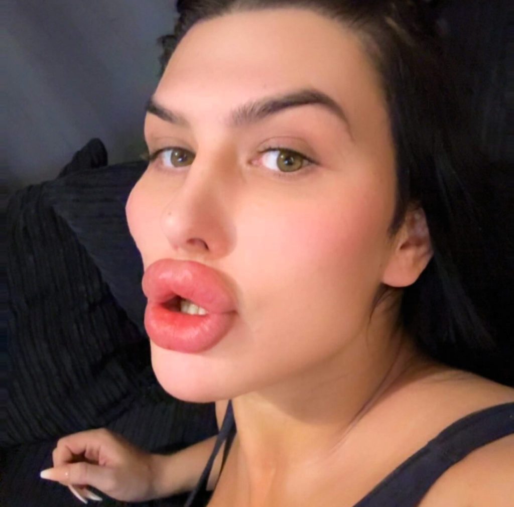 Sofia Lips spent over £500,000 on surgery and now dissolves filler to reveal her natural face for the first time in 10 years - but says she feels embarrassed without it.