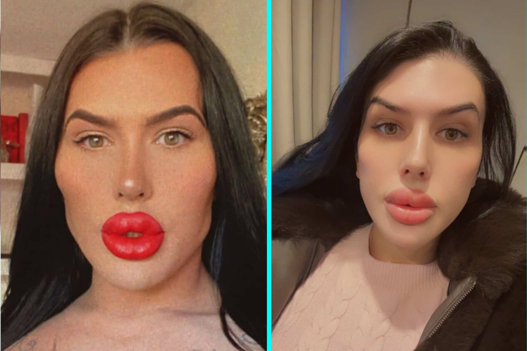 Sofia Lips spent over £500,000 on surgery and now dissolves filler to reveal her natural face for the first time in 10 years - but says she feels embarrassed without it.