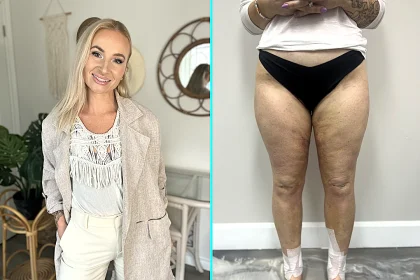 Woman branded "lazy" by doctors for gaining weight in her legs finally discovered the truth after a late-night Google search - Laura Kerr had lipedema, a chronic condition.