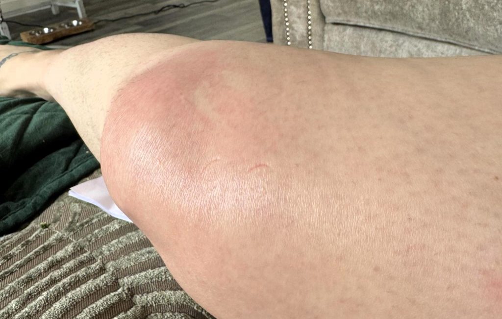 Salon owner Nicky Richardson was told she was too young for arthritis - but after years of daily pain she went private and was diagnosed with four chronic conditions at once.