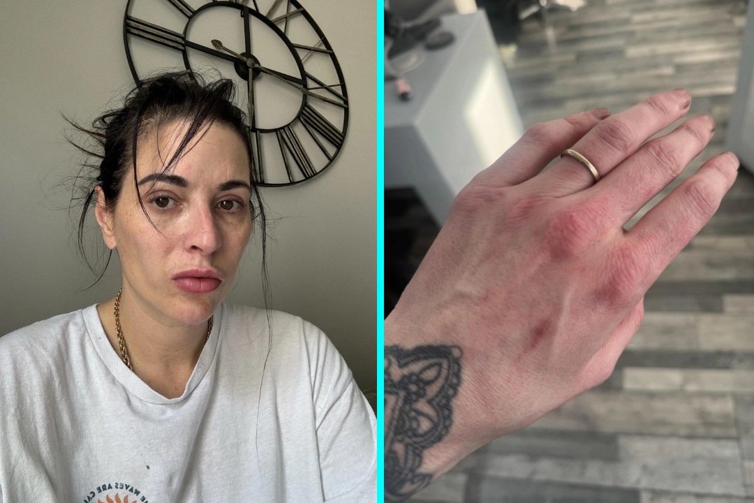 Salon owner Nicky Richardson was told she was too young for arthritis - but after years of daily pain she went private and was diagnosed with four chronic conditions at once.