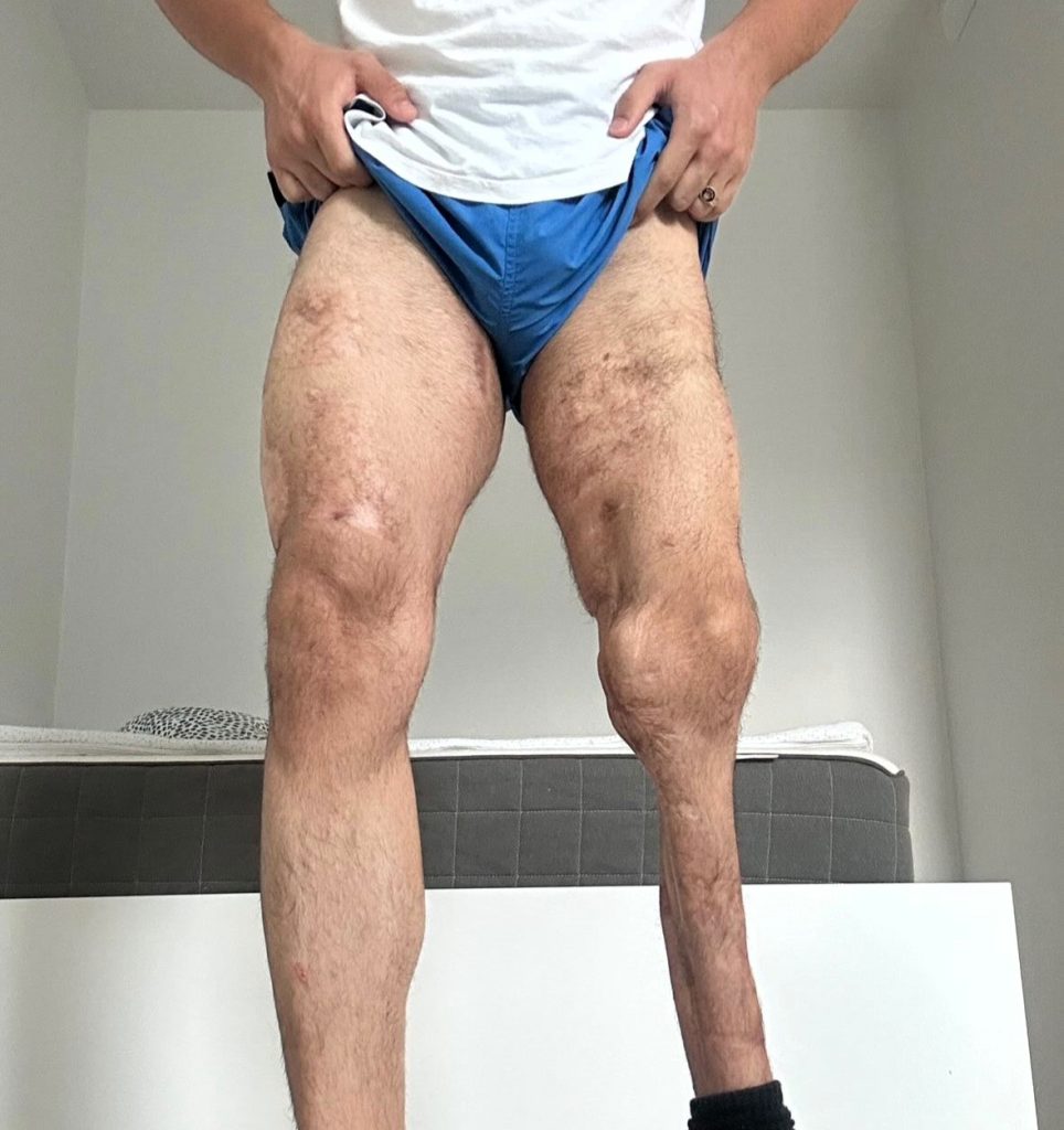 Farshid Esmaeili's leg was crushed at age 12 and doctors urged amputation - but after 27 surgeries he defied the odds and now lifts heavy weights at the gym every day.