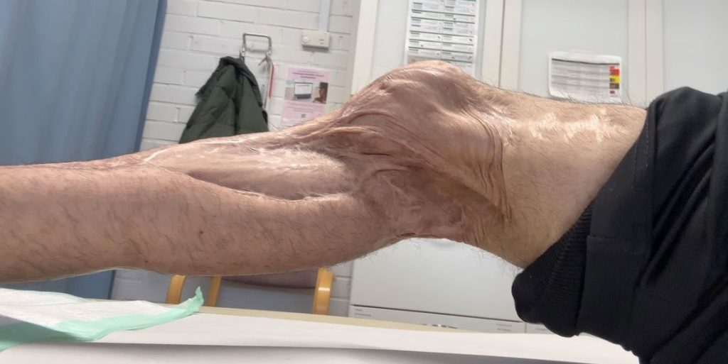 Farshid Esmaeili's leg was crushed at age 12 and doctors urged amputation - but after 27 surgeries he defied the odds and now lifts heavy weights at the gym every day.