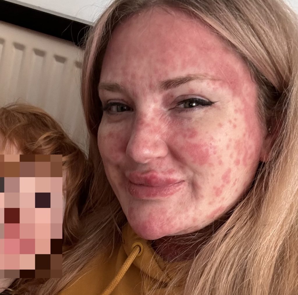 Jayne Walmsley was left unrecognisable after a severe measles rash covered her head to toe - then got the surprise of her life when removing her contraceptive patch led to an unplanned pregnancy.