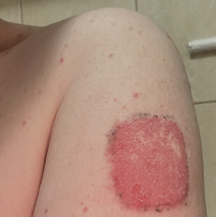 Jayne Walmsley was left unrecognisable after a severe measles rash covered her head to toe - then got the surprise of her life when removing her contraceptive patch led to an unplanned pregnancy.