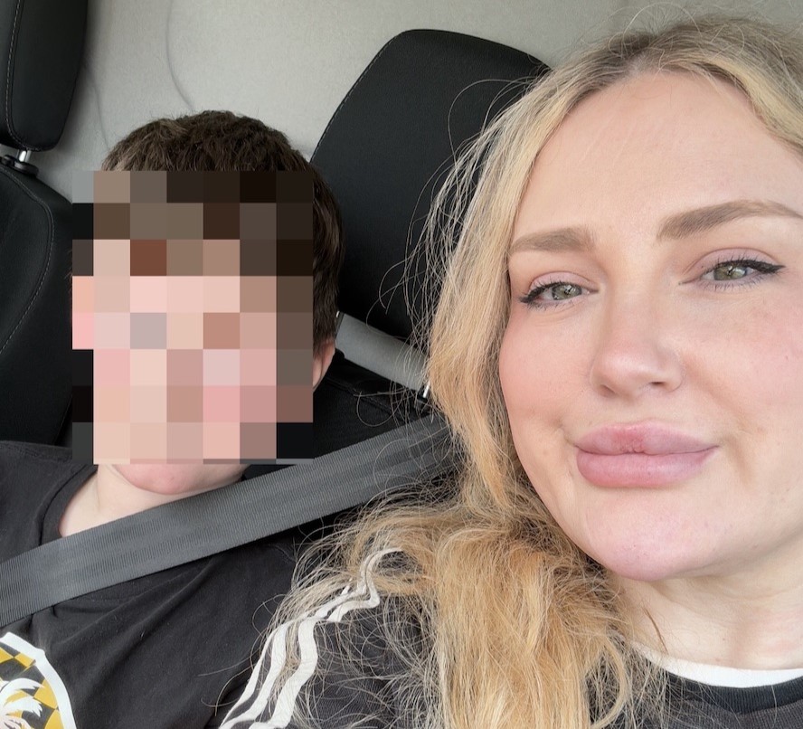 Jayne Walmsley was left unrecognisable after a severe measles rash covered her head to toe - then got the surprise of her life when removing her contraceptive patch led to an unplanned pregnancy.