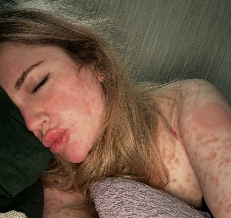 Jayne Walmsley was left unrecognisable after a severe measles rash covered her head to toe - then got the surprise of her life when removing her contraceptive patch led to an unplanned pregnancy.