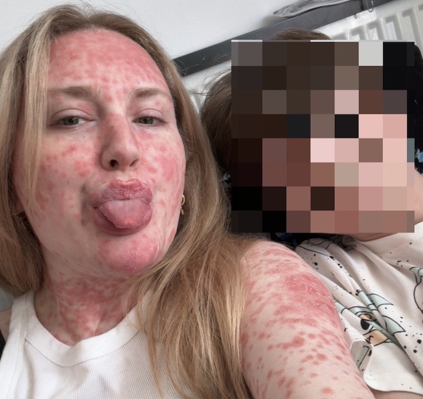 Jayne Walmsley was left unrecognisable after a severe measles rash covered her head to toe - then got the surprise of her life when removing her contraceptive patch led to an unplanned pregnancy.