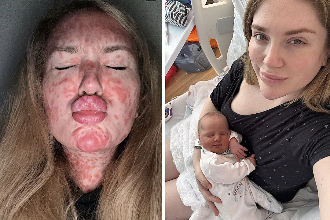 Jayne Walmsley was left unrecognisable after a severe measles rash covered her head to toe - then got the surprise of her life when removing her contraceptive patch led to an unplanned pregnancy.