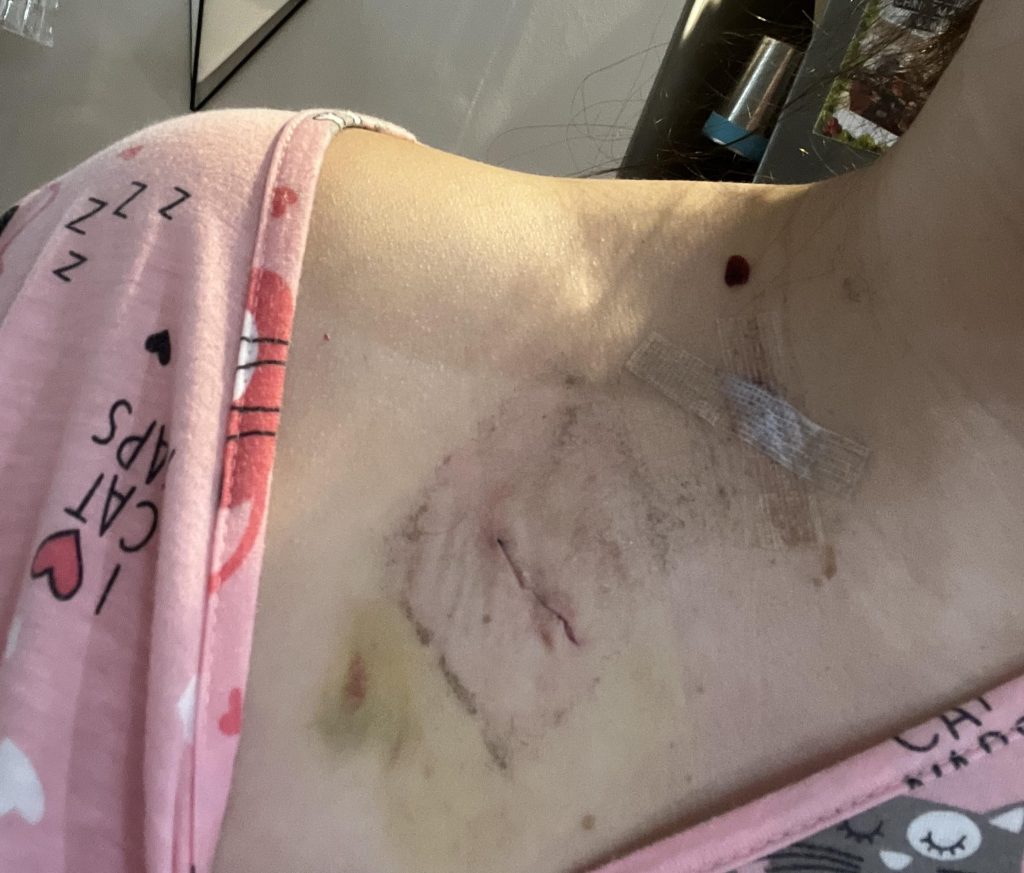 A 27-year-old woman ignored bloating and blood in her stool - only to be diagnosed with stage four colon cancer that cost her both ovaries and her chance of having children.
